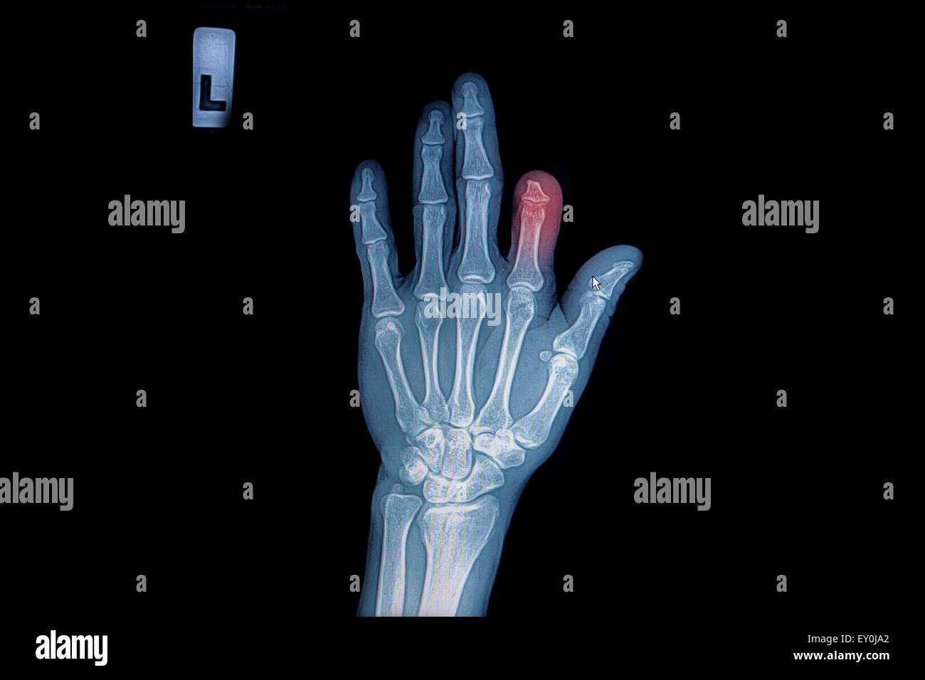 X-ray of trauma hand and finger Stock Photo