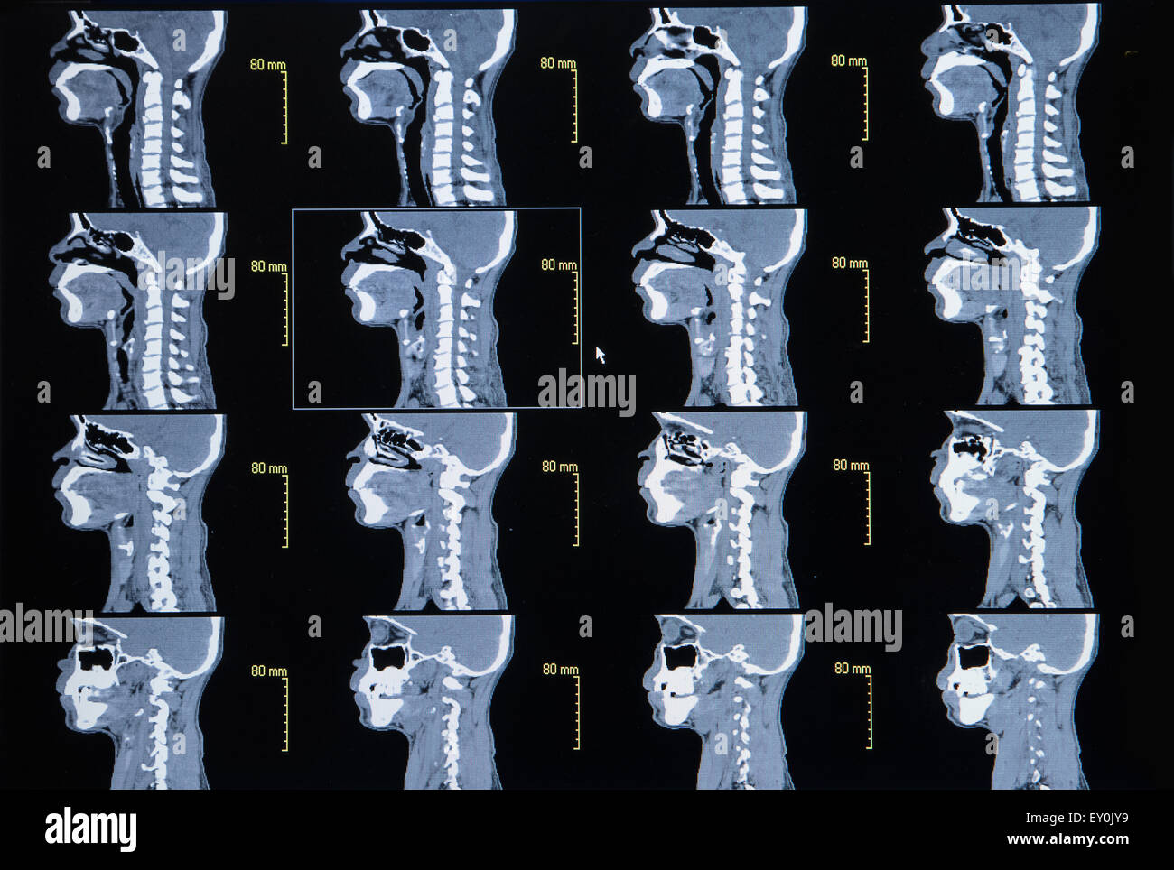 Series of images from a computerized tomography of neck (cervical bone) Stock Photo