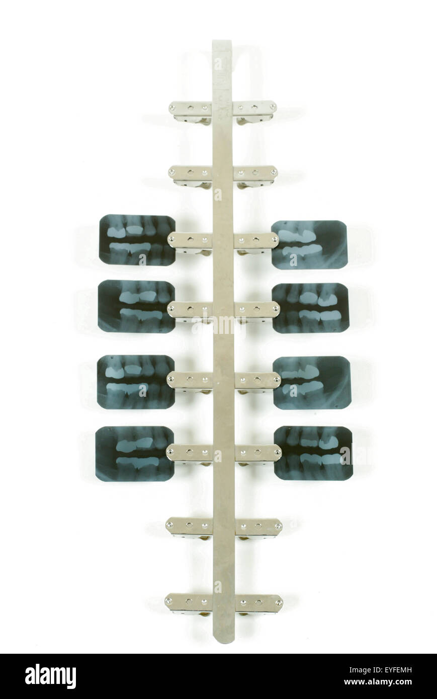 Bitewing dental x-ray images are displayed on a special dental film holder. The bitewing view is taken to visualize the crowns of the posterior teeth and the height of the alveolar bone and are commonly used to examine for cavities. Stock Photo
