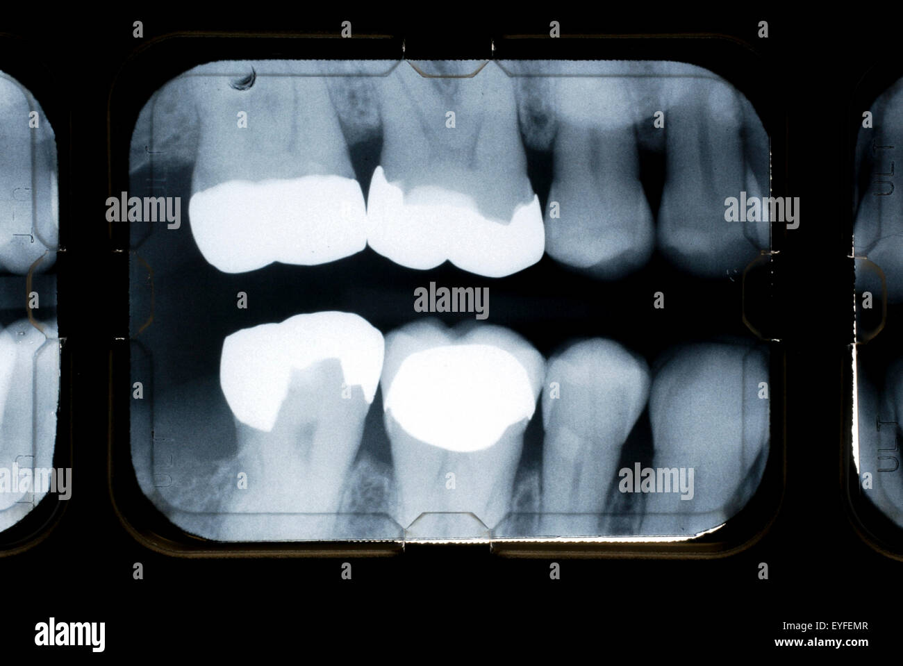 Bitewing x-rays show the crowns of the posterior teeth and the height of the alveolar bone and are commonly used to examine for cavities. Note white areas showing fillings. Stock Photo