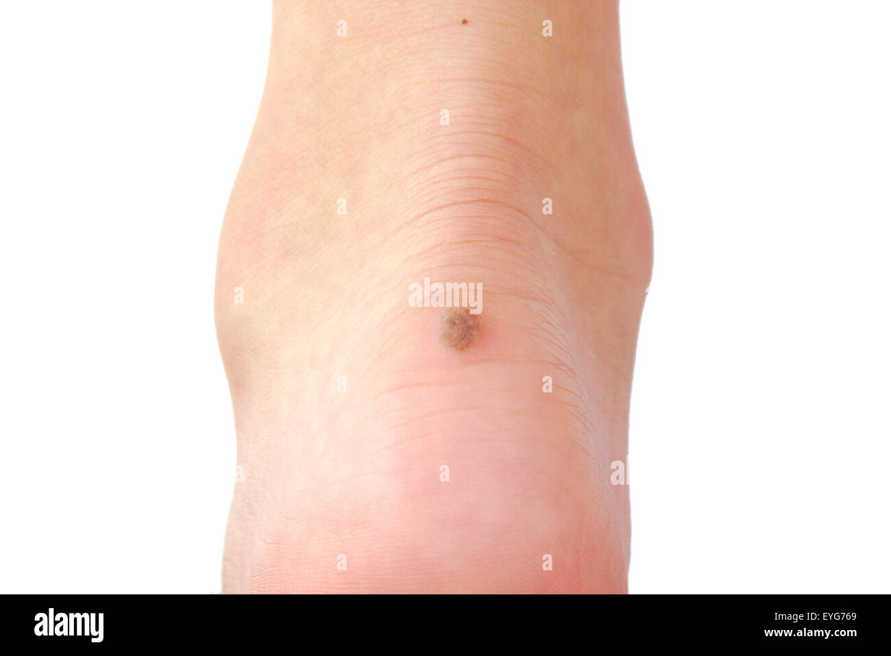 Wart on a person's heel close up Stock Photo