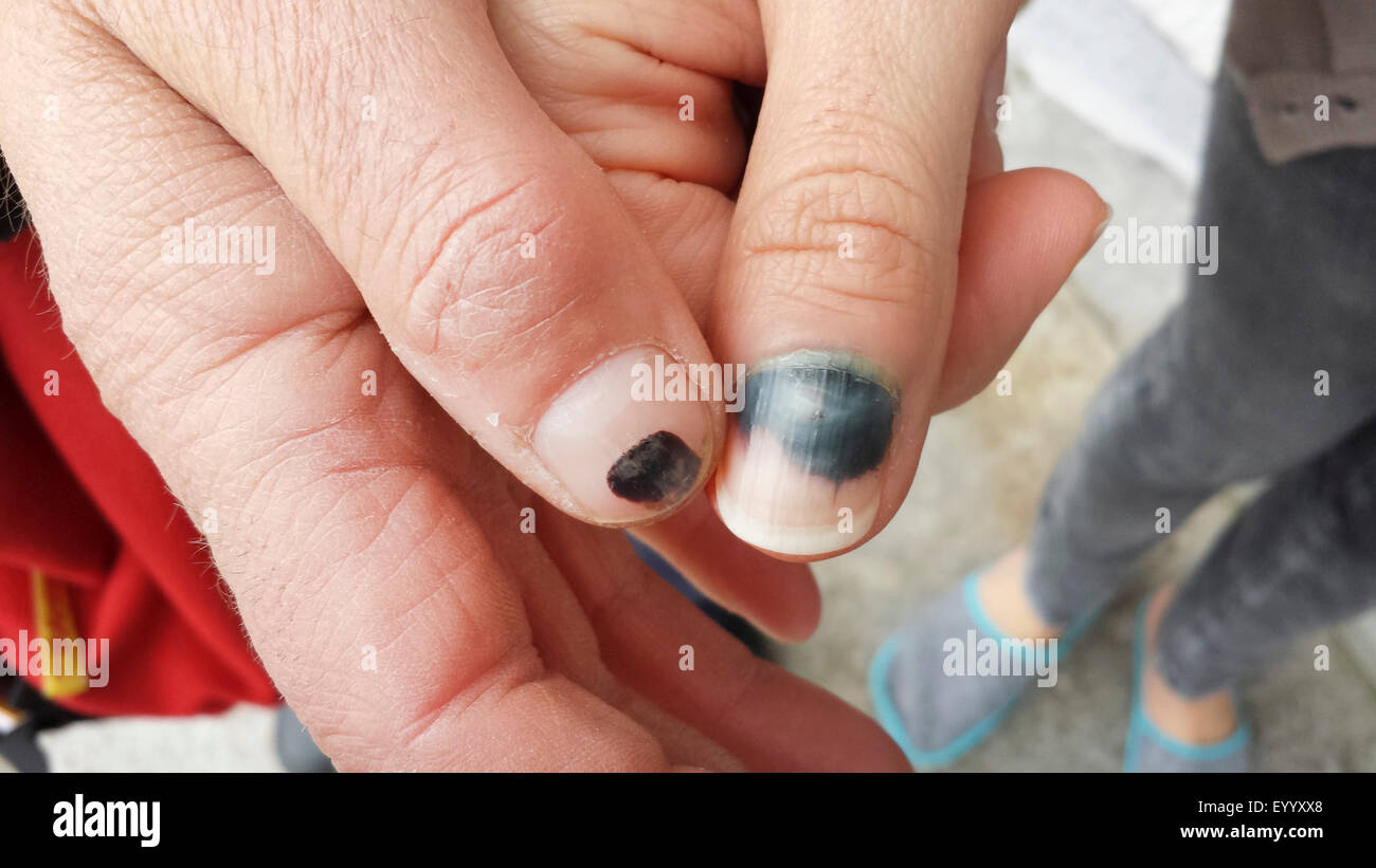 Subungual Hematoma Blood Clot Under Nail Removal | Auburn Medical Group -  YouTube