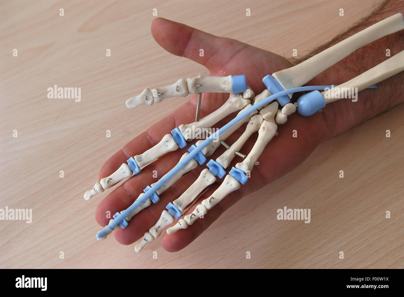 Orthopedic Institute Galeazzi (Milan, Italy), prosthesis of hand ligament Stock Photo
