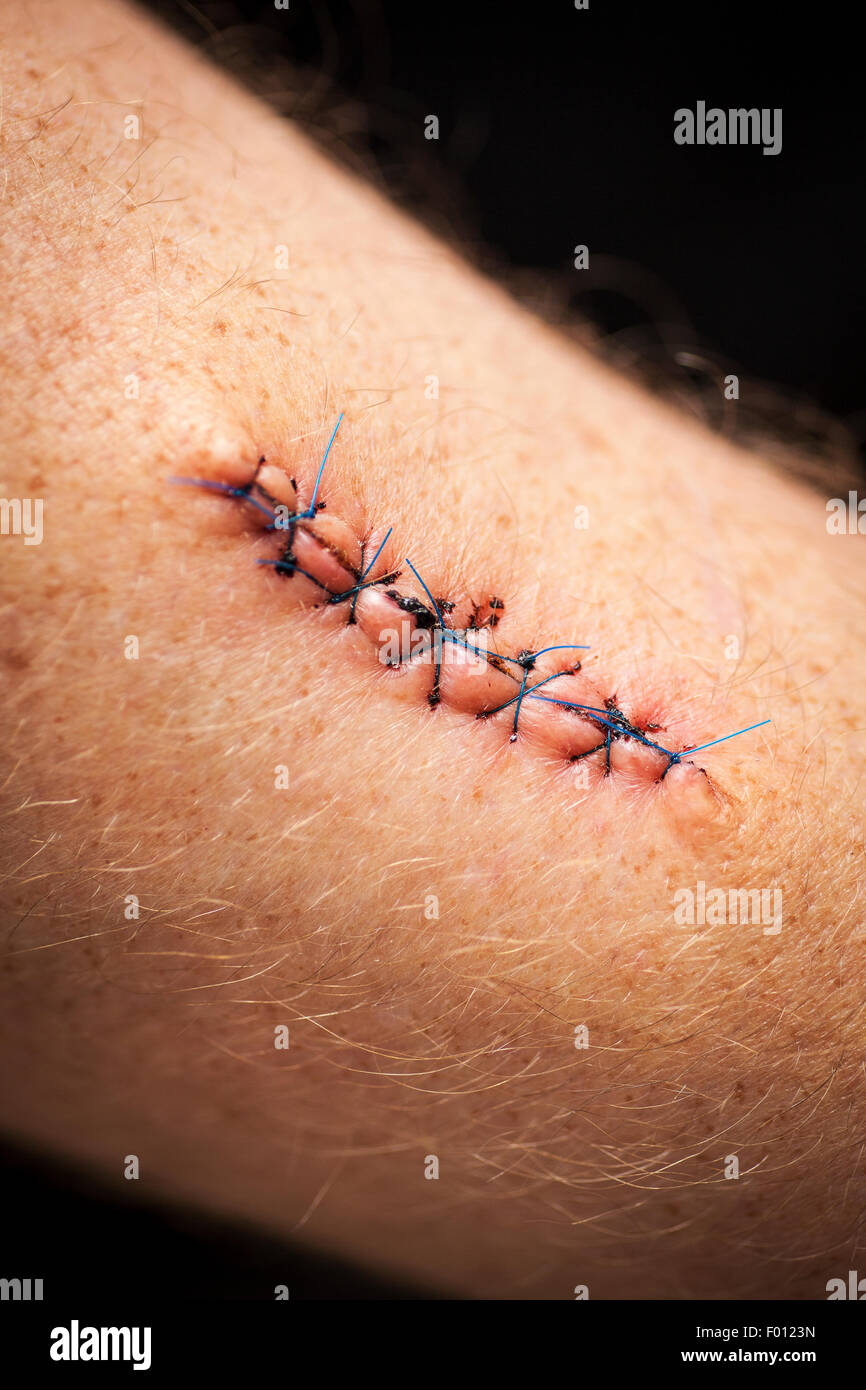 Stitched skin after a medical procedure to remove a cancerous mole Stock Photo
