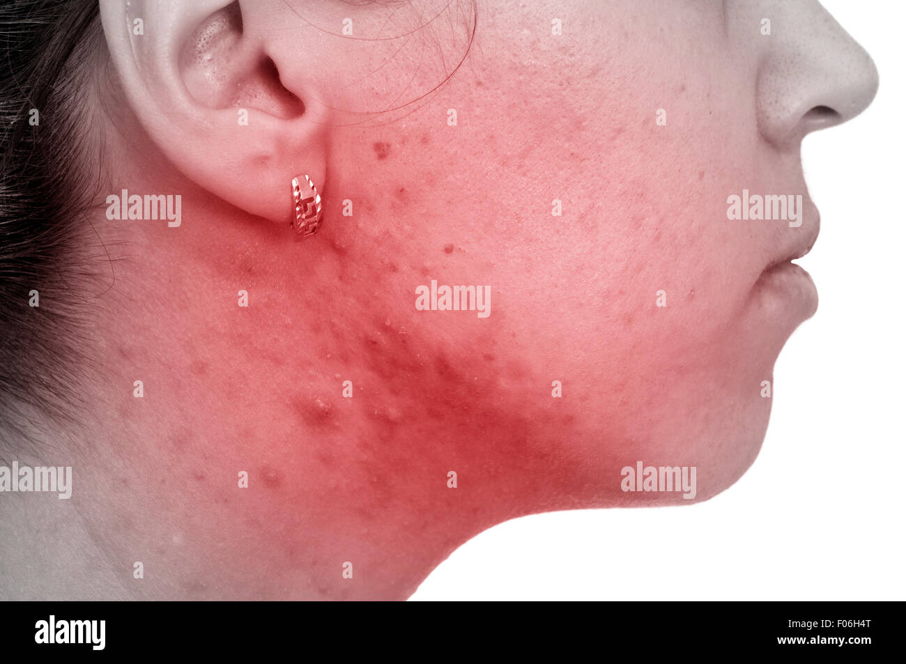 Female have a problems with her skin Stock Photo - Alamy