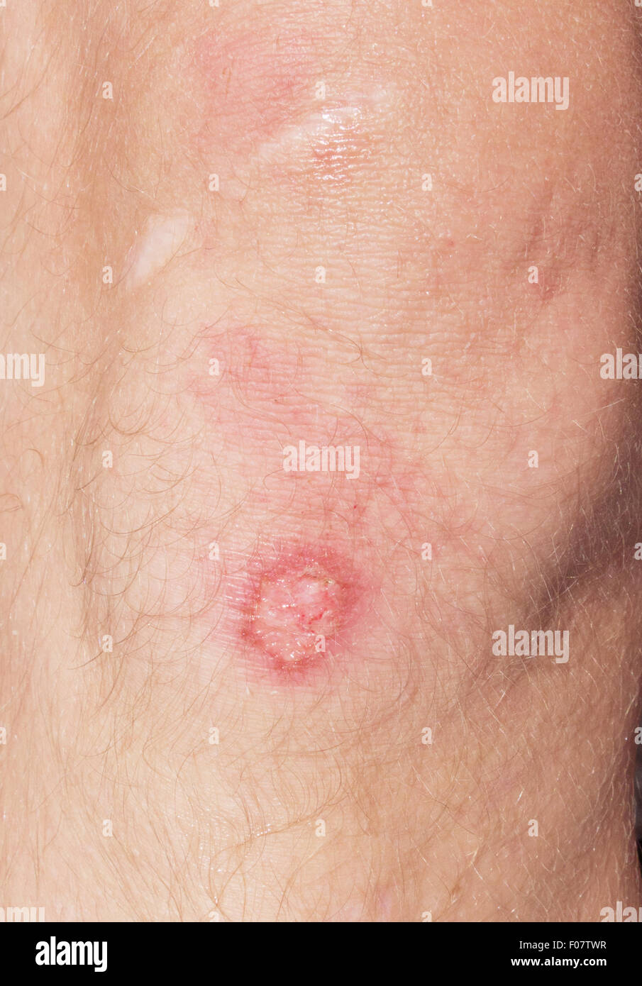 wound on a knee Stock Photo Alamy