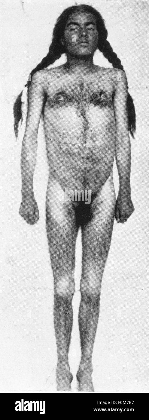 medicine, anomaly, hirsutism, young woman with strong androgenic hair, full length, standing, body, bodies, naked, hairiness, androgenic hair, hair, medicine, medicines, anomaly, anomalies, historic, historical, woman, women, female, Additional-Rights ... medicine, anomaly, hirsutism, young woman with strong androgenic hair, full length, standing, body, bodies, naked, hairiness, androgenic hair, hair, medicine, medicines, anomaly, anomalies, historic, historical, woman, women, female, Additional-Rights ...