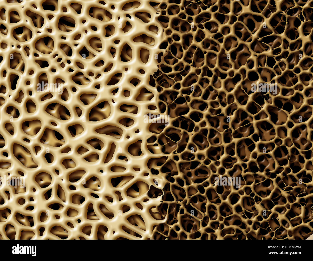 Bone with osteoperosis medical anatomy concept as a strong healthy and normal spongy tissue against unhealthy porous weak skeleton structure due to aging or illness. Stock Photo