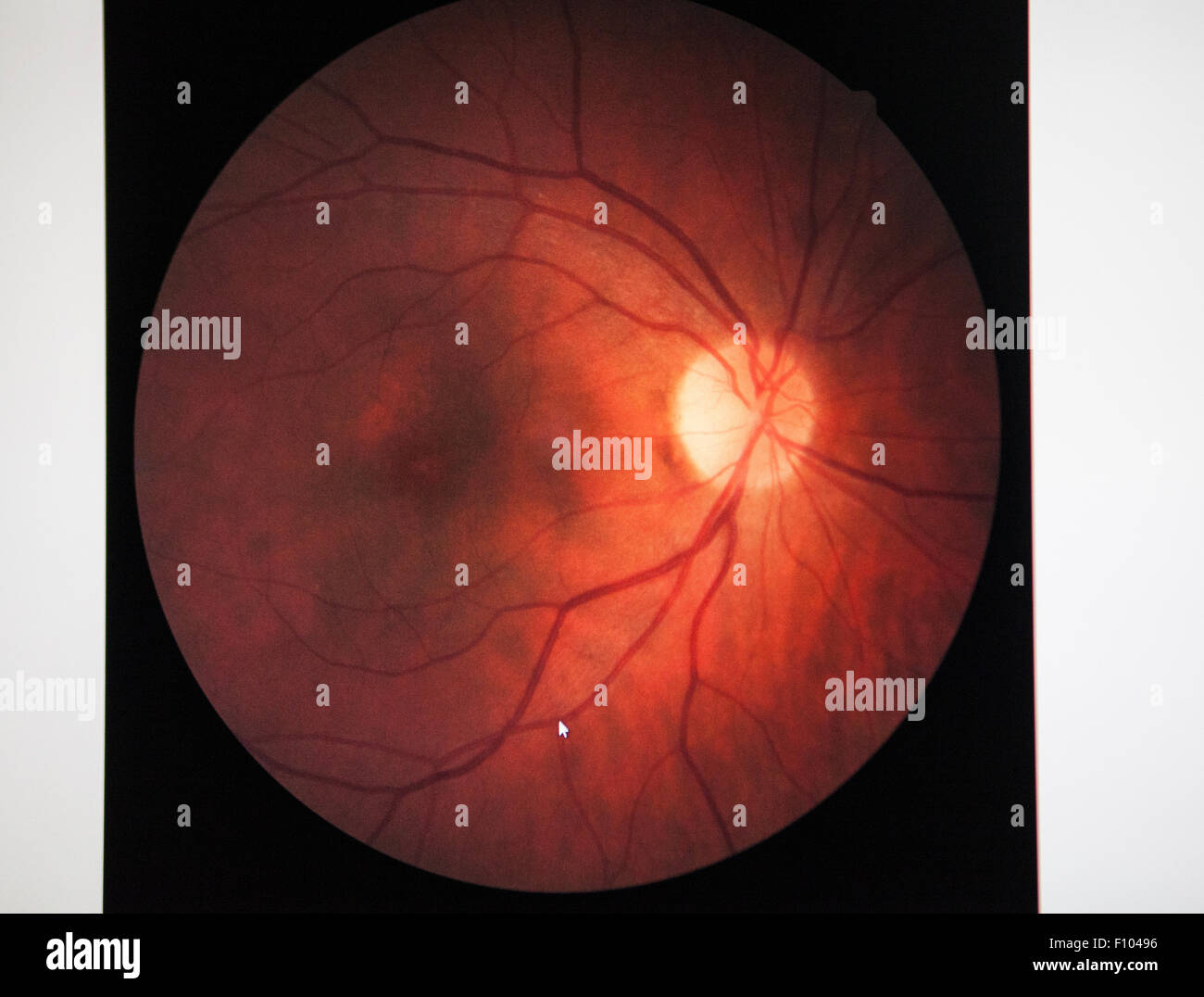 RETINAL EDEMA Stock Photo