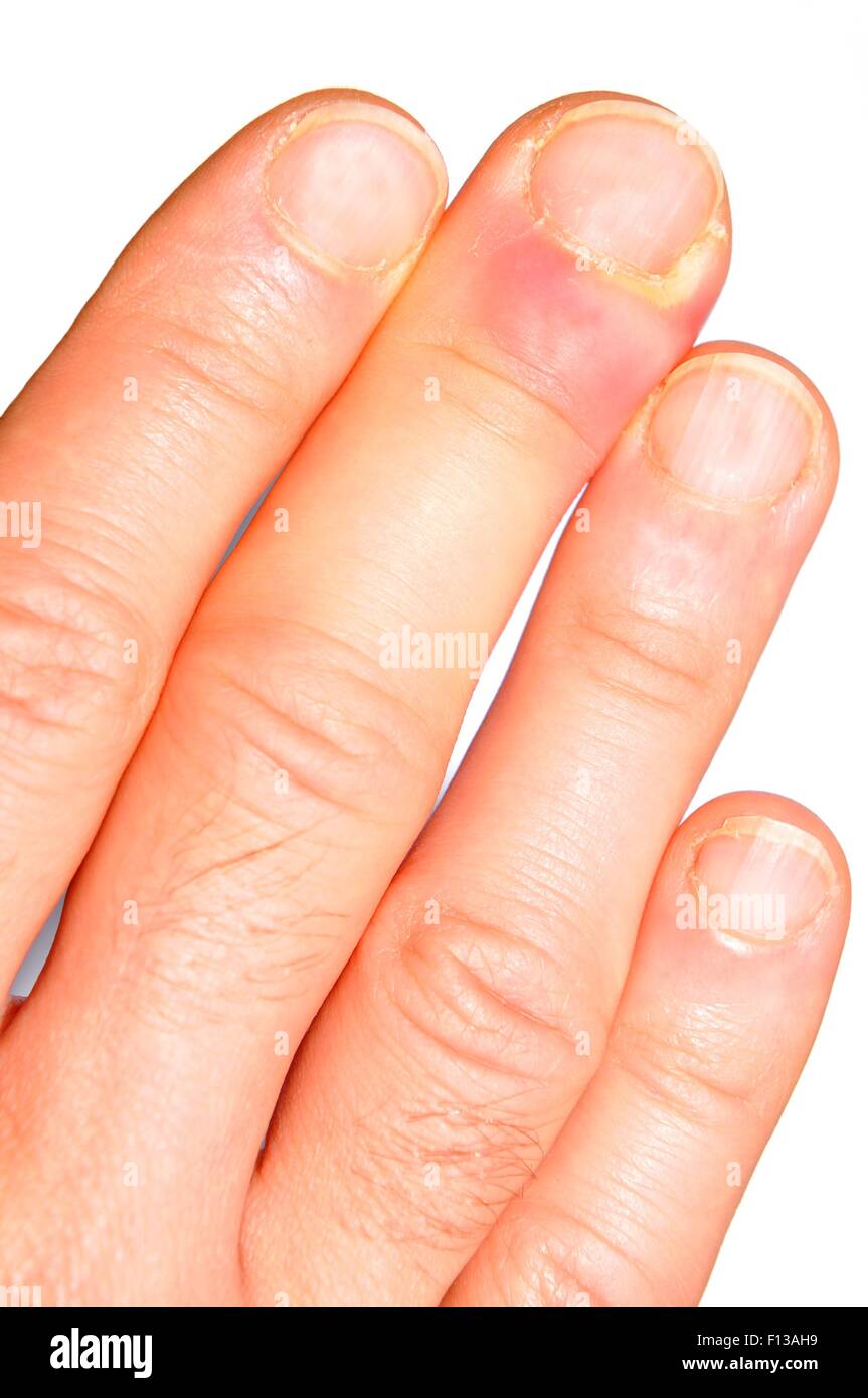 Abscess hand hires stock photography and images Alamy