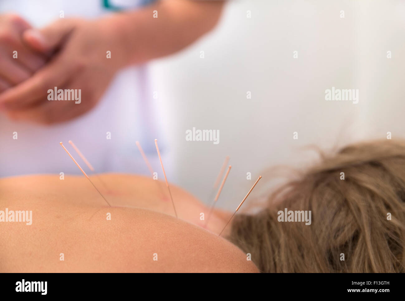 Acupuncture needles on back of a young woman Stock Photo