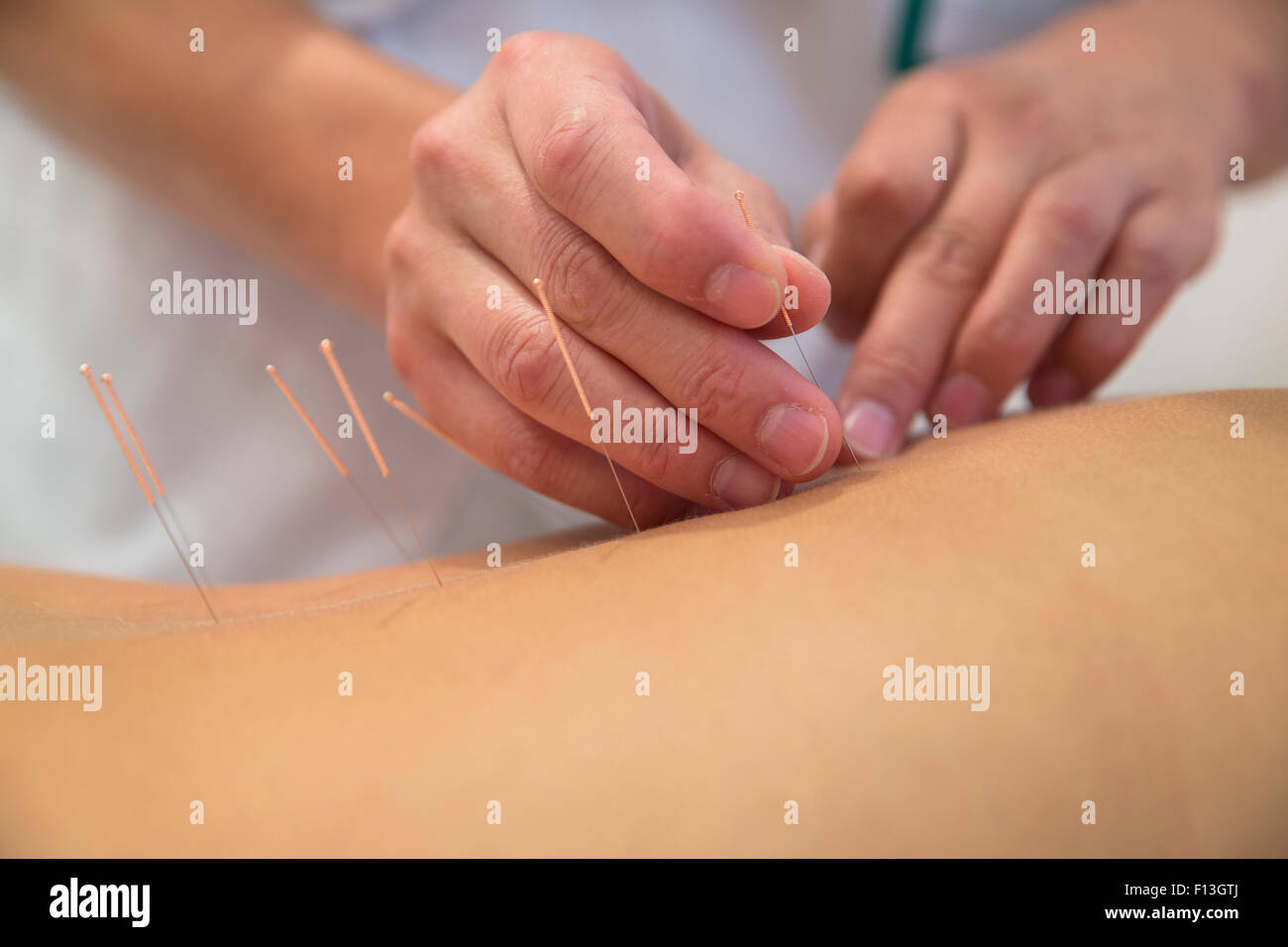 Acupuncture needles on back of a young woman Stock Photo