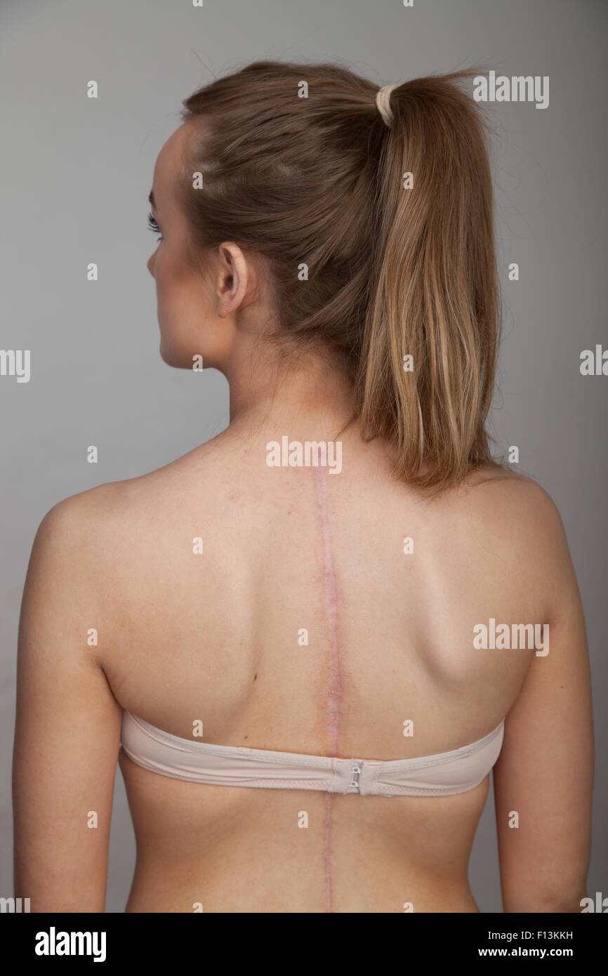 Sixteen year old girl showing the scar of a major back operation. Stock Photo