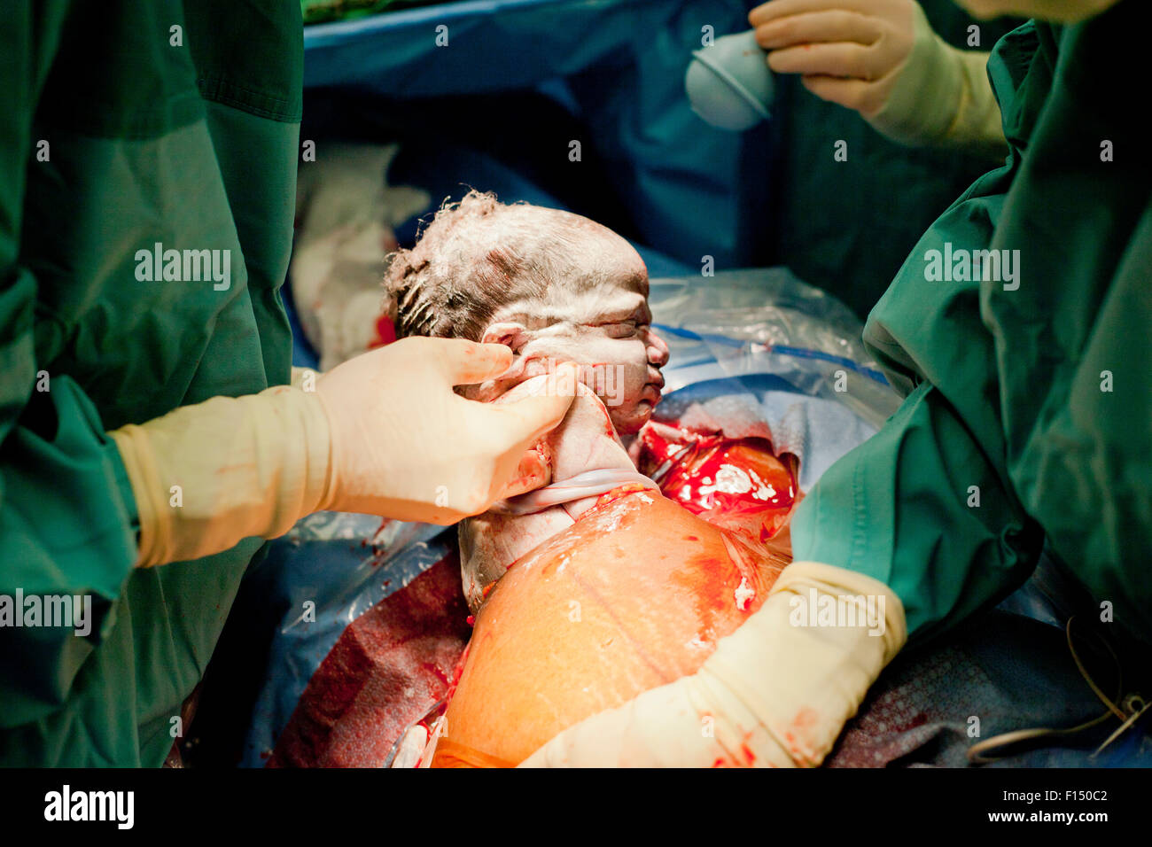 Baby being born via cesarian section operation Stock Photo