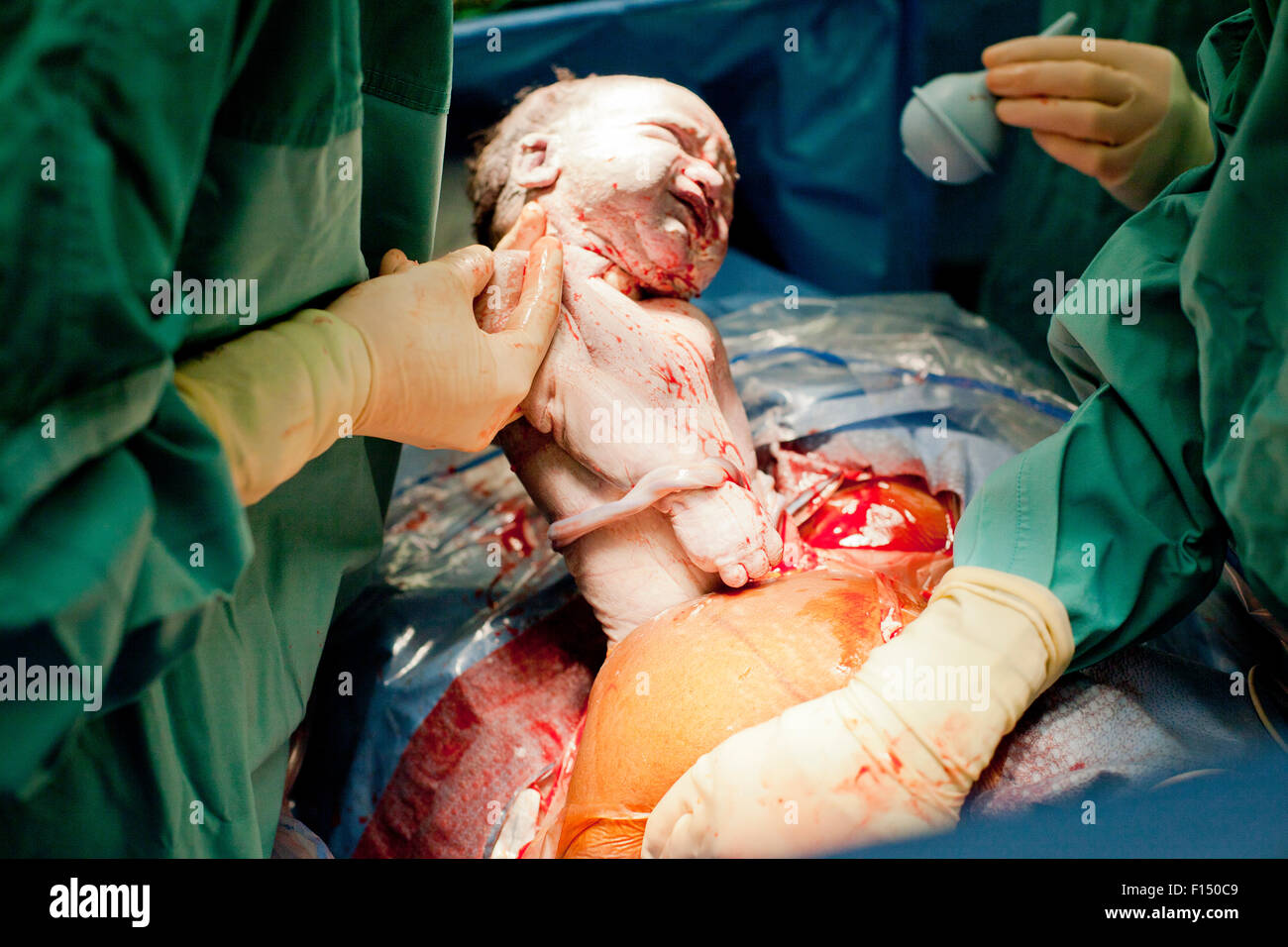 Baby being born via cesarian section operation Stock Photo