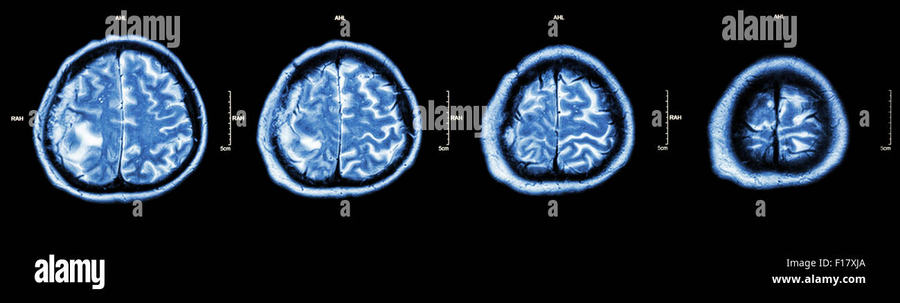 Brain tumor  ( Film CT-scan of brain : show part of brain with tumor ) Stock Photo