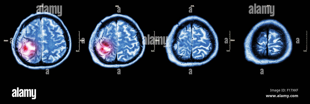 Brain tumor  ( Film CT-scan of brain : show part of brain with tumor ) Stock Photo