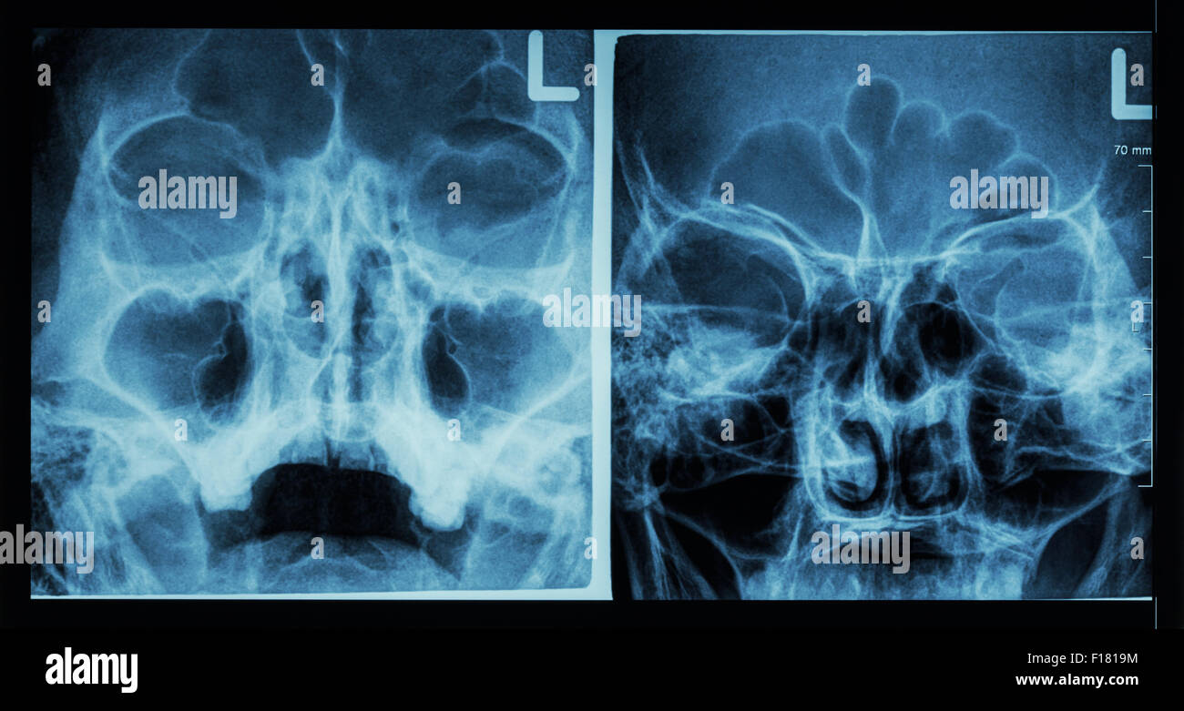 Film x-ray paranasal sinus show frontal sinus , maxillary sinus , ethmoid sinus Stock Photo