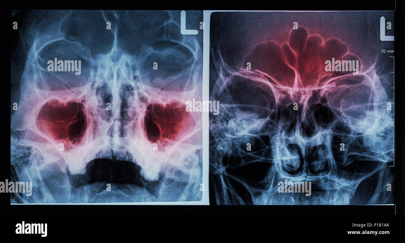Film X-ray paranasal sinus : show sinusitis at maxillary sinus ( left image ) , frontal sinus ( right image ) Stock Photo