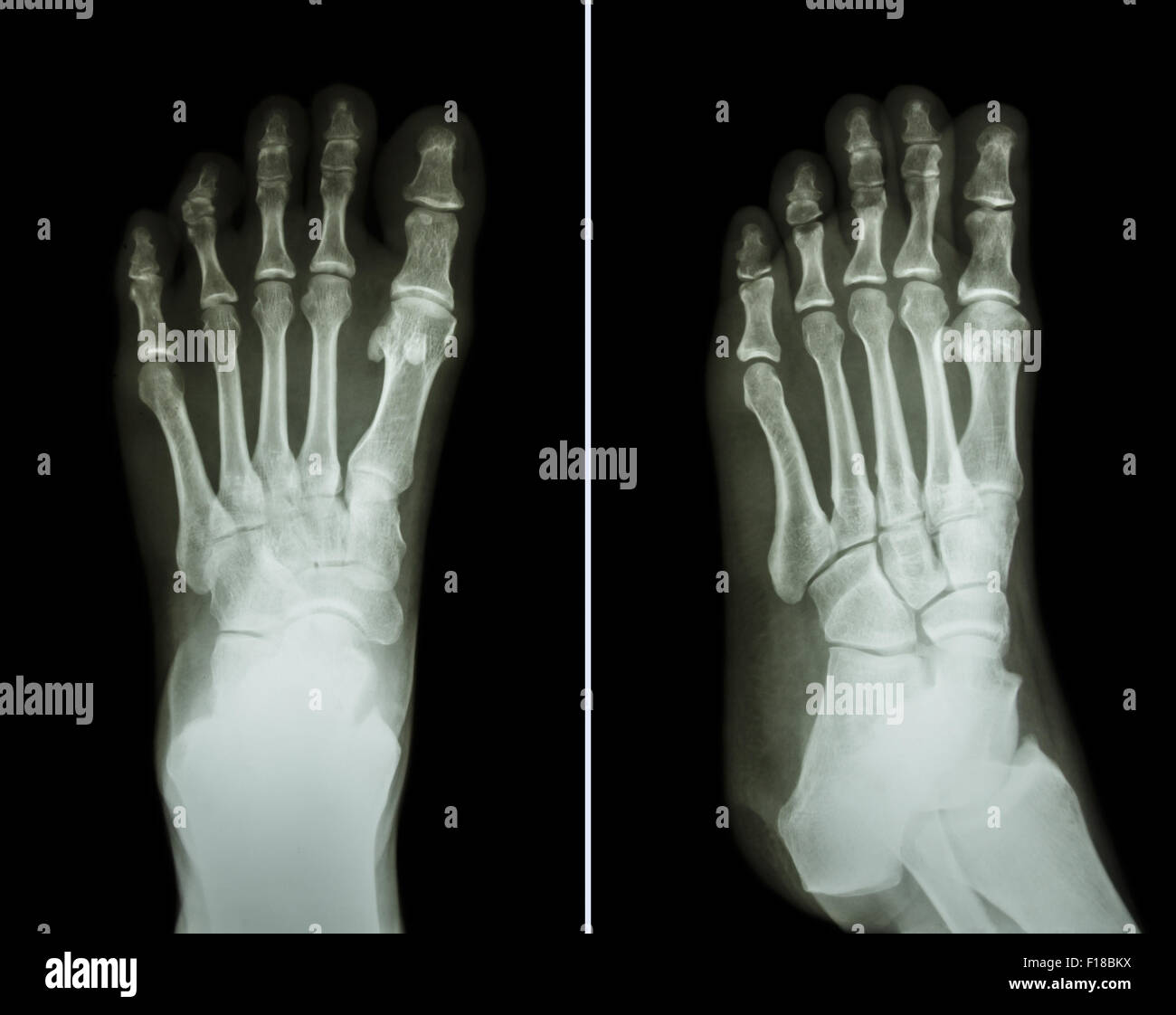 Film x-ray both foot ( 2 position : front view and side view ) Stock Photo