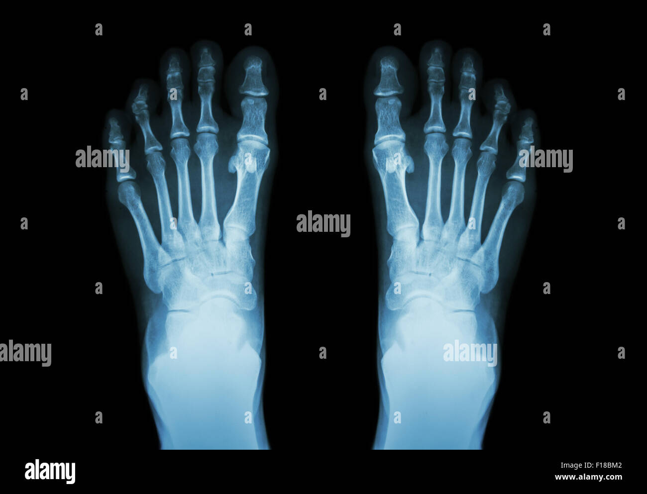 Film x-ray both foot ( front view ) Stock Photo
