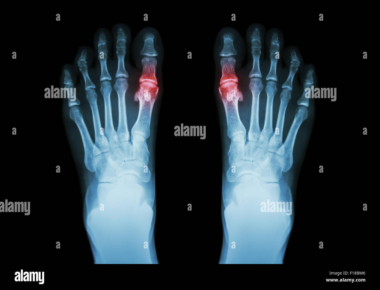 Gout , Rheumatoid arthritis ( Film x-ray both foot and arthritis at