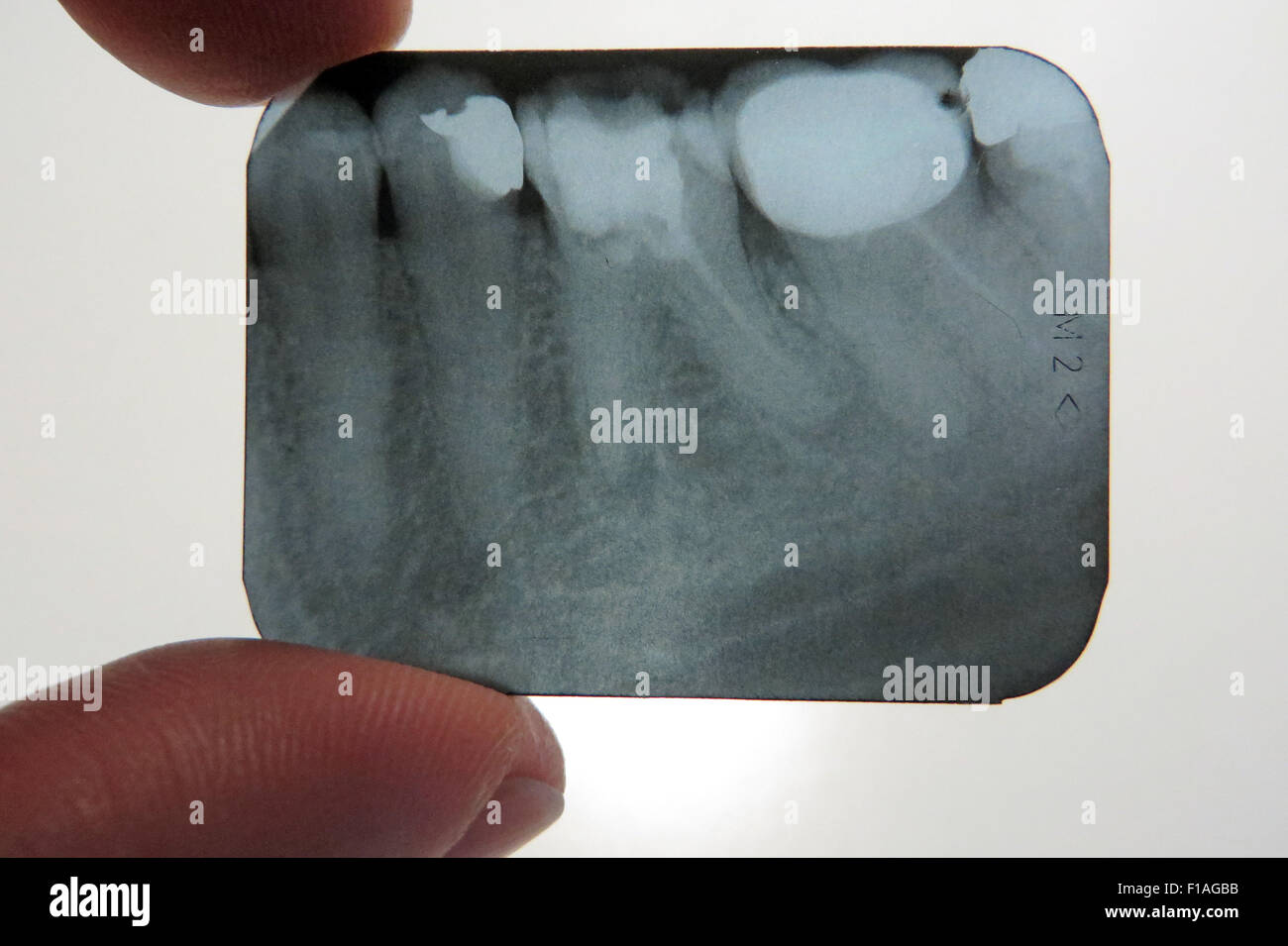 Berlin, Germany, chest x-ray of root canal treatment, crowned and sealed teeth Stock Photo