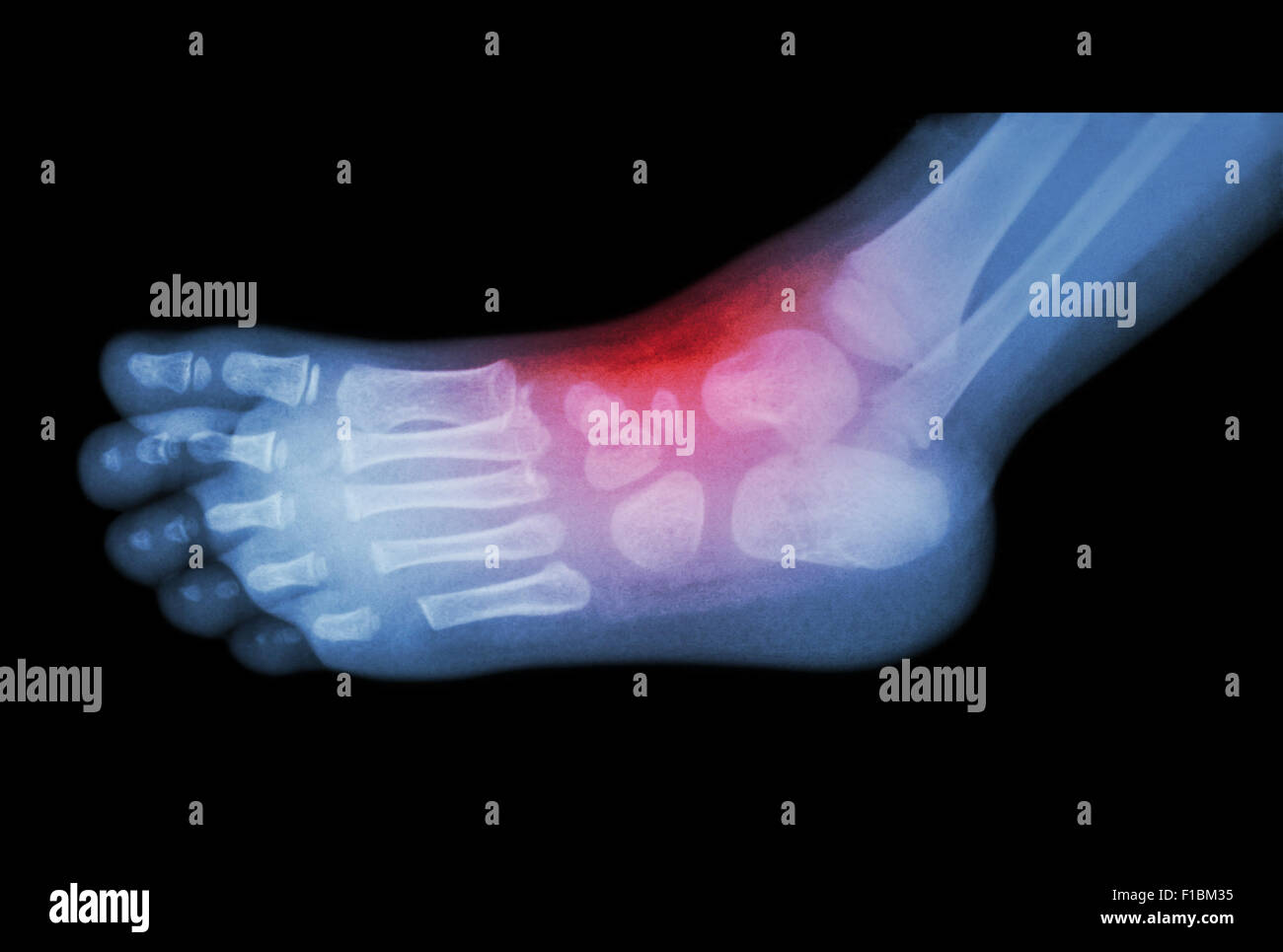 Arthritis and injury at ankle film xray of child 's foot ( side view