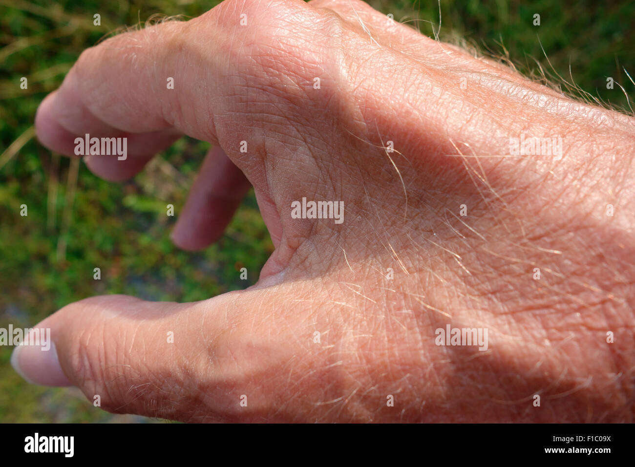 Muscle wasting and atrophy between the thumb and forefinger of the hand due to Ulnar neuropathy this being a major symptom Stock Photo