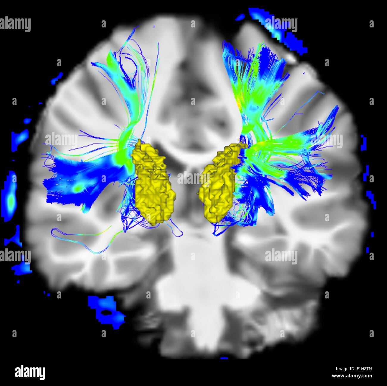 Coronal view human brain Parkinson's disease. Yellow surface is caudate blue/green areas highlight fibers motor system Stock Photo