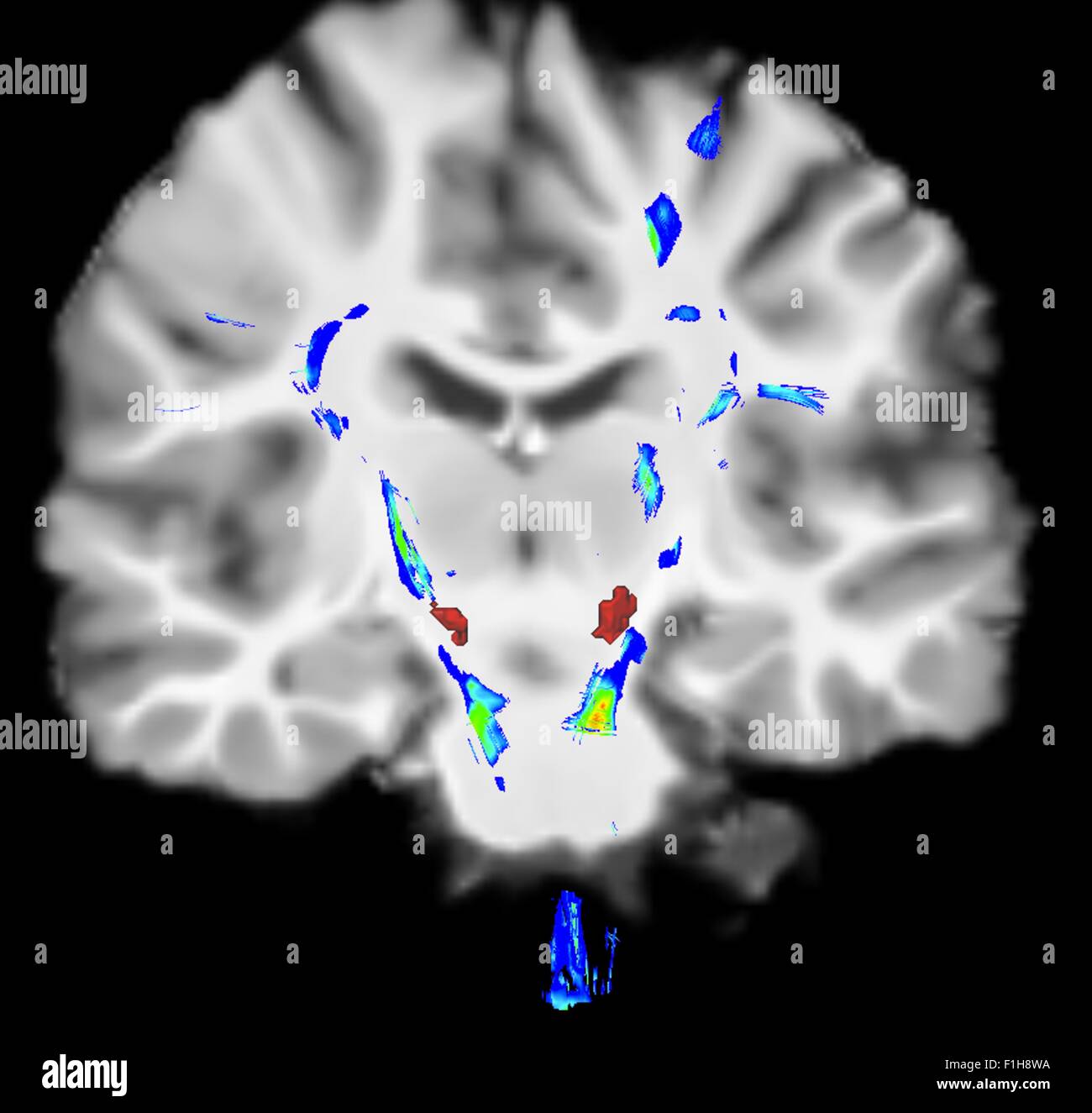 Coronal view human brain Parkinson's disease. Blue/green areas highlight fibers motor system red area is substancia nigra Stock Photo