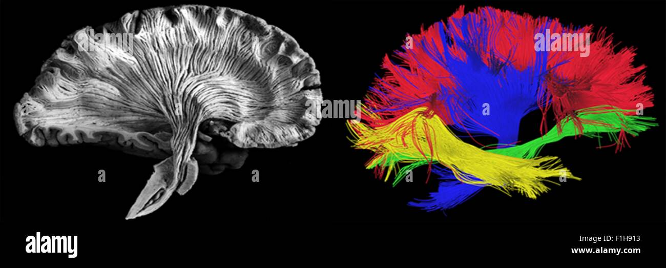 Left - picture of a human brain dissection by a neuroanatomist, Right - reconstructed fibers by tractography Stock Photo