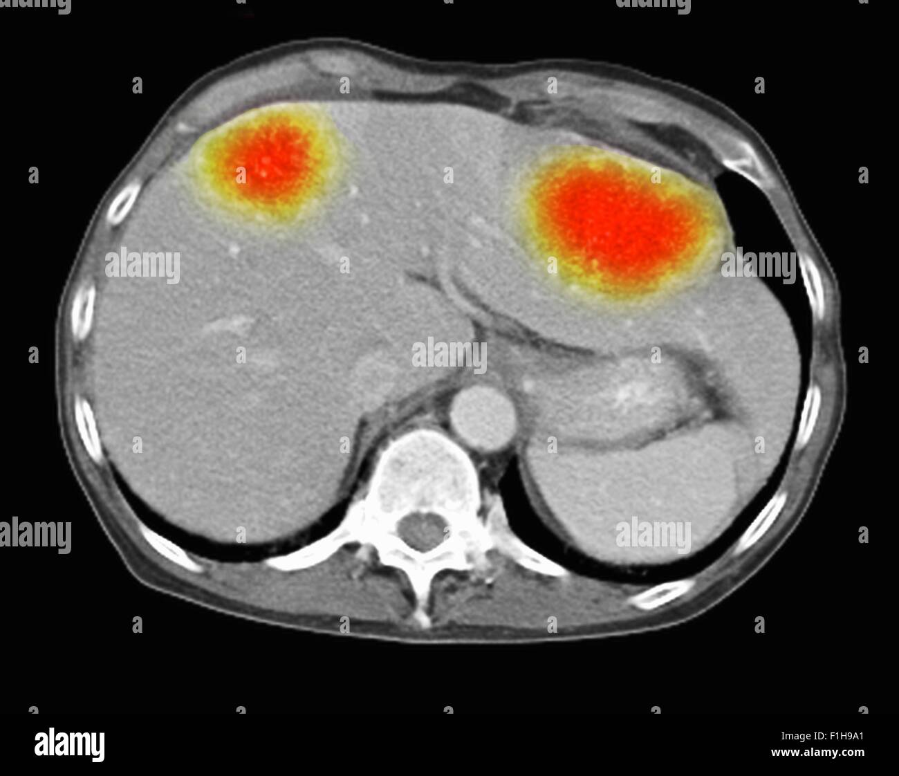 Image co-registered PET-CT study dual modality scanner. Patient multiple metastatic lesions liver & lung Stock Photo