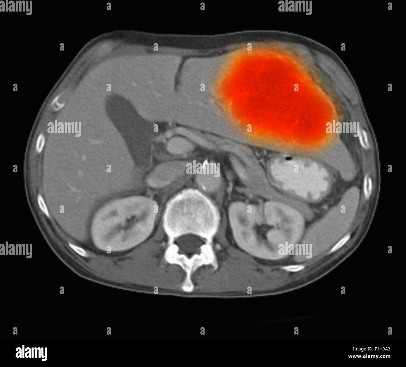 Image co-registered PET-CT study dual modality scanner. Patient multiple metastatic lesions liver & lung Stock Photo