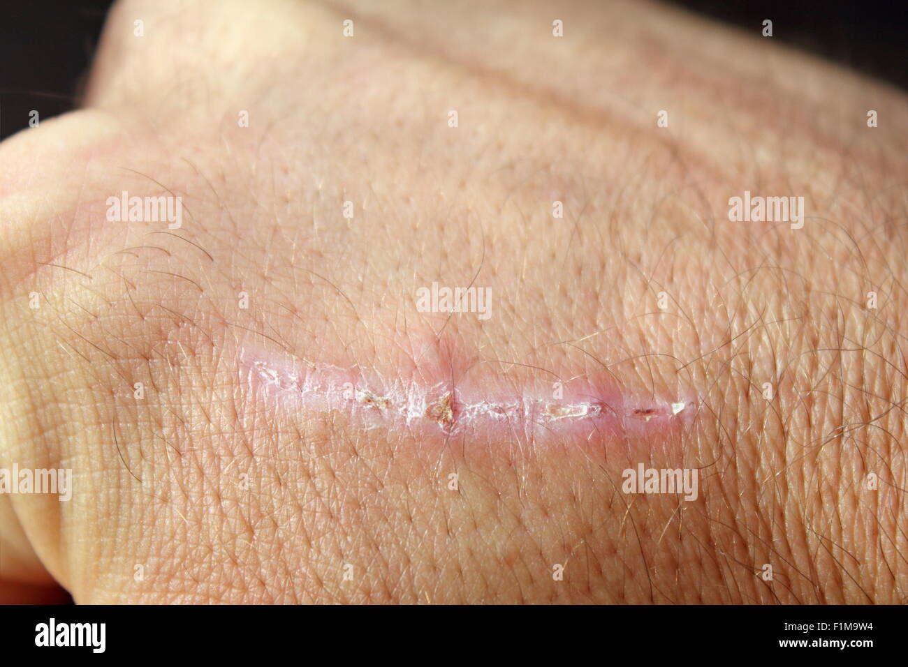 wound healing scar on man's hand Stock Photo