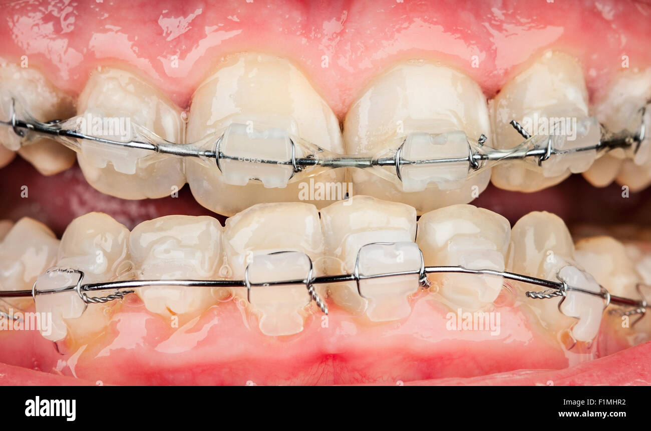 Braces for overbite hi-res stock photography and images - Alamy