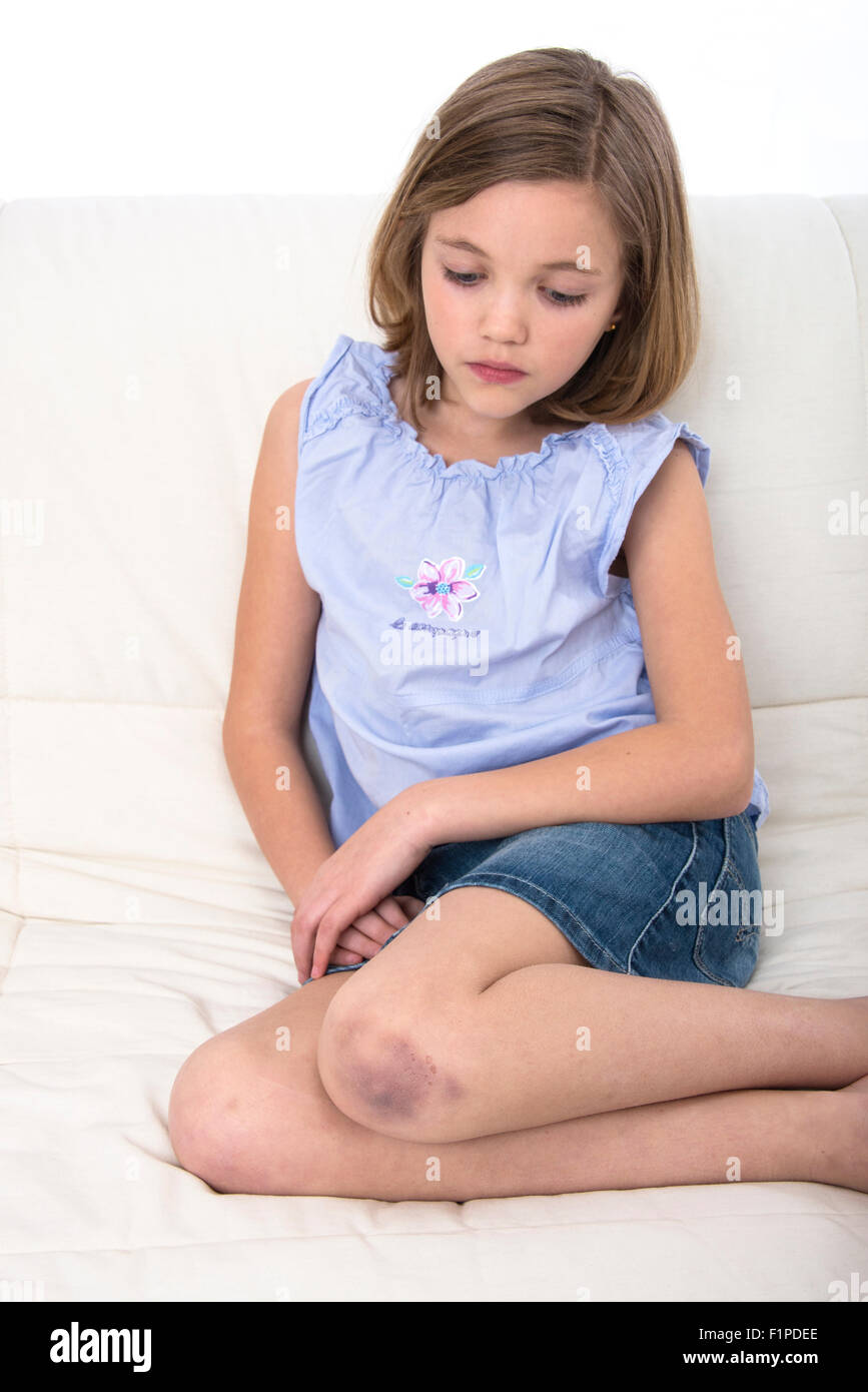 knee bruises