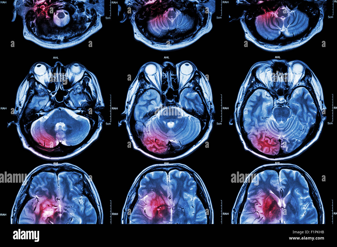 Film MRI ( resonance imaging ) of brain ( This MRI of brain is normal brain but red