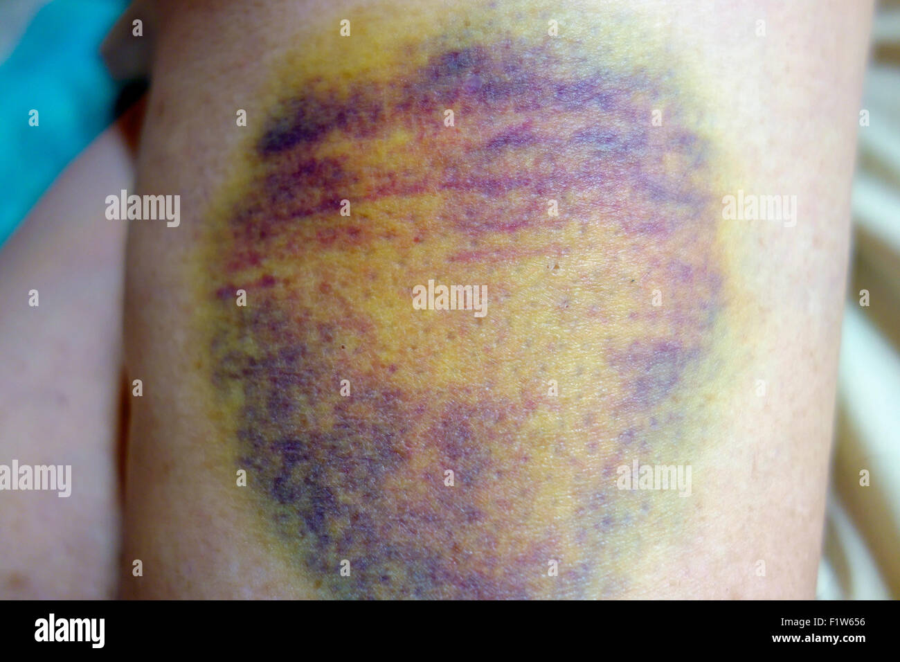 A very large bruise, contusion or hematoma on a woman's leg or thigh skin showing black, blue and yellow discoloration Stock Photo