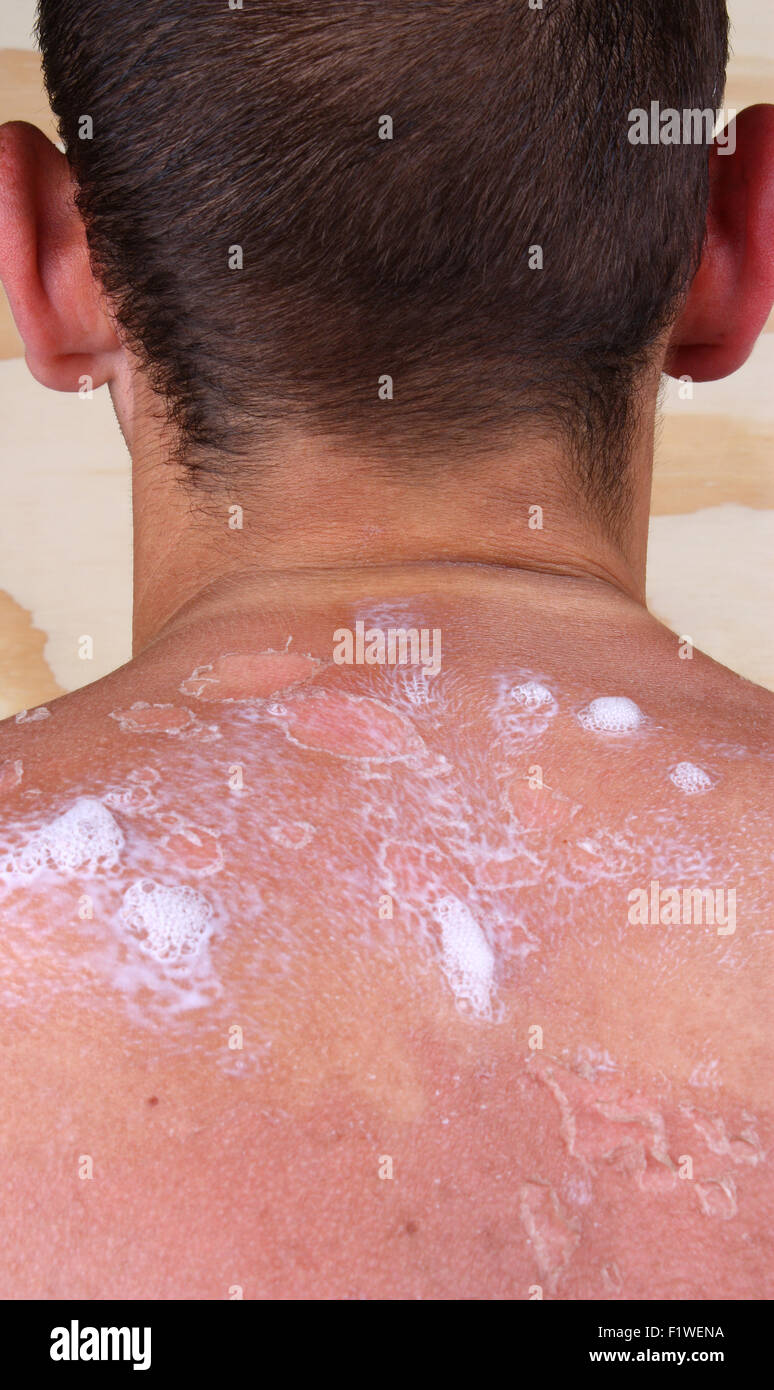 Treatment of severe sunburn in men Stock Photo