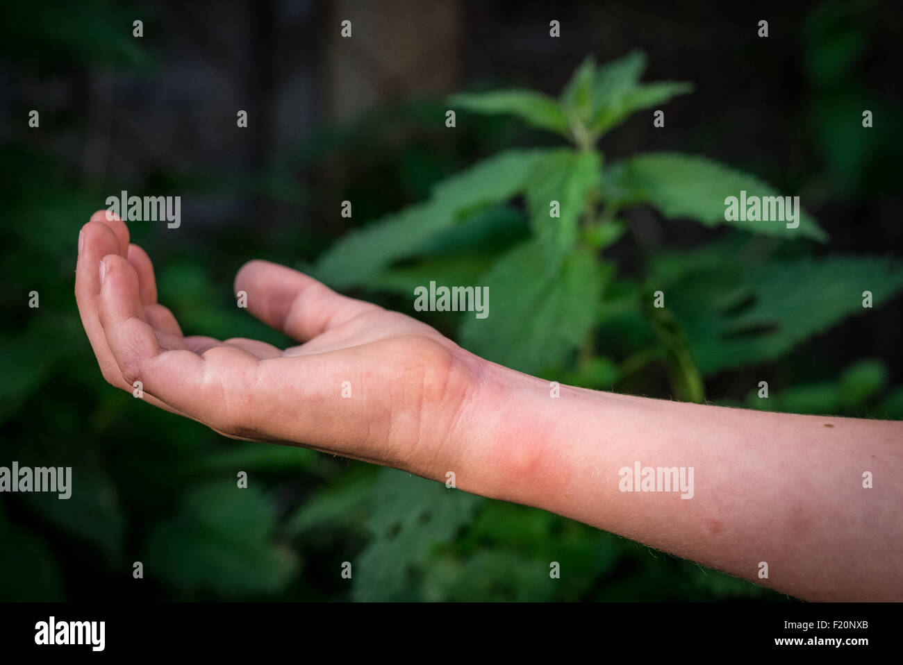 A boys arm with a rash caused by a stinging nettle Stock Photo