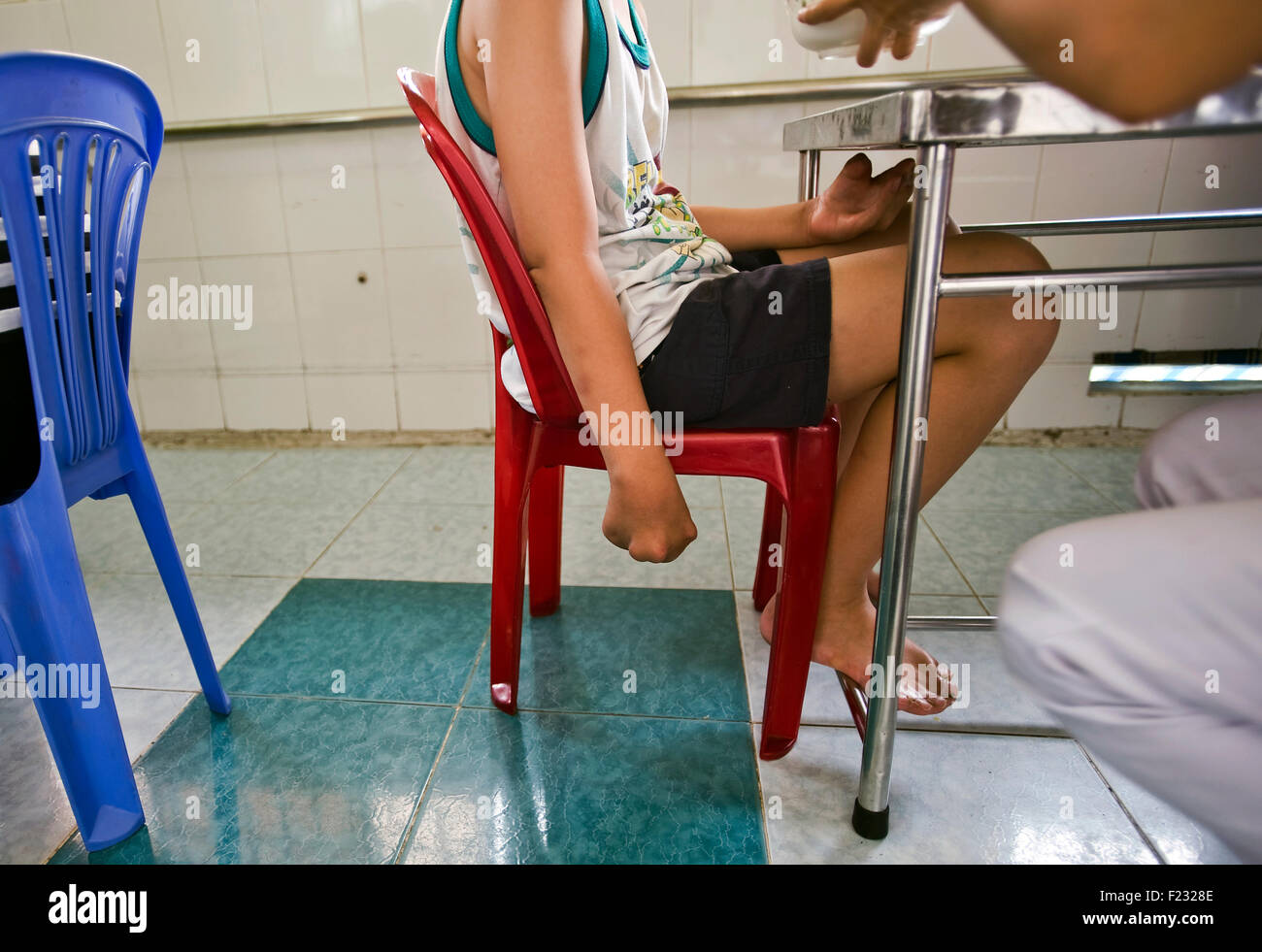 A boy born with deformed limbs at Peace Village at Tudu Hospital in Ho Chi Minh City, Vietnam. Stock Photo