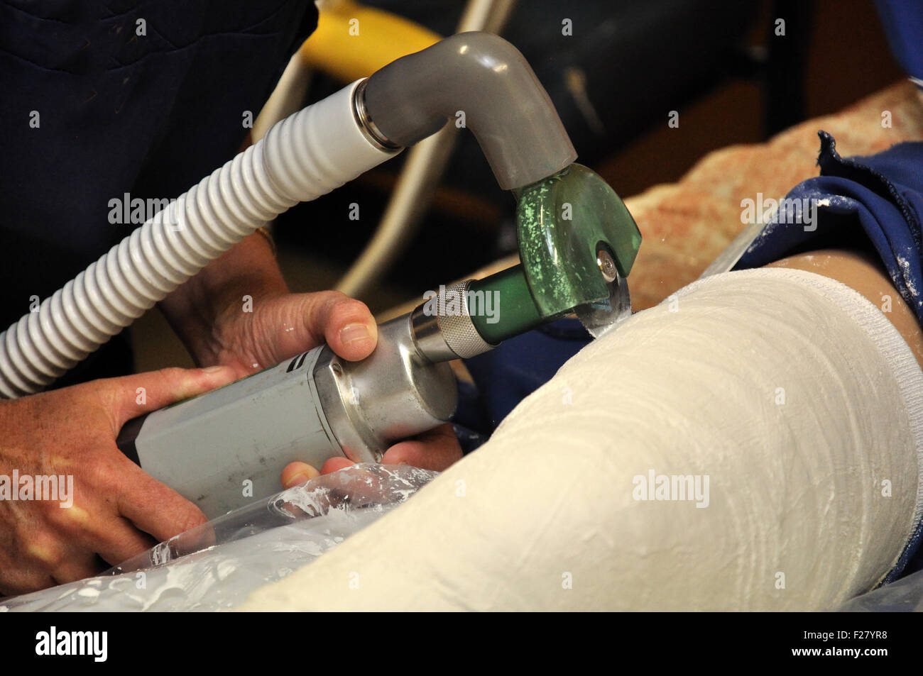 a nurse cuts the plaster cast on a boy's broken leg Stock Photo