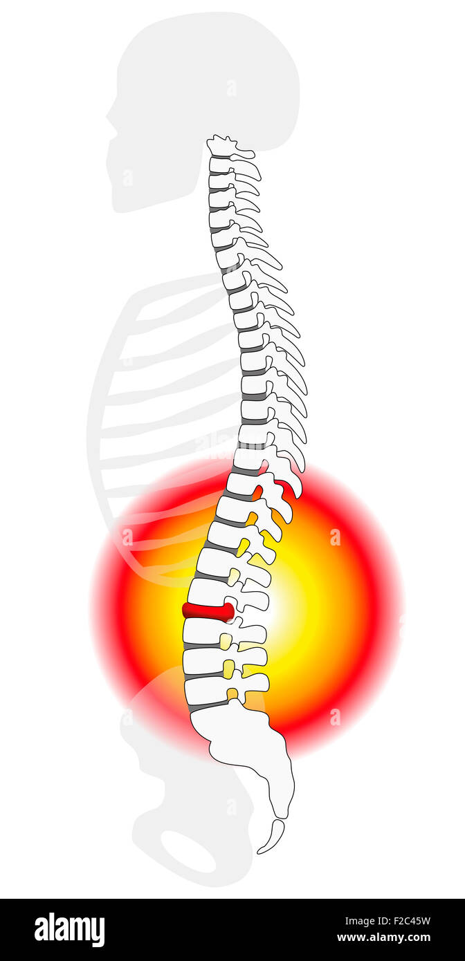 Spinal disc herniation or prolapse at a human vertebral column - profile view. Stock Photo