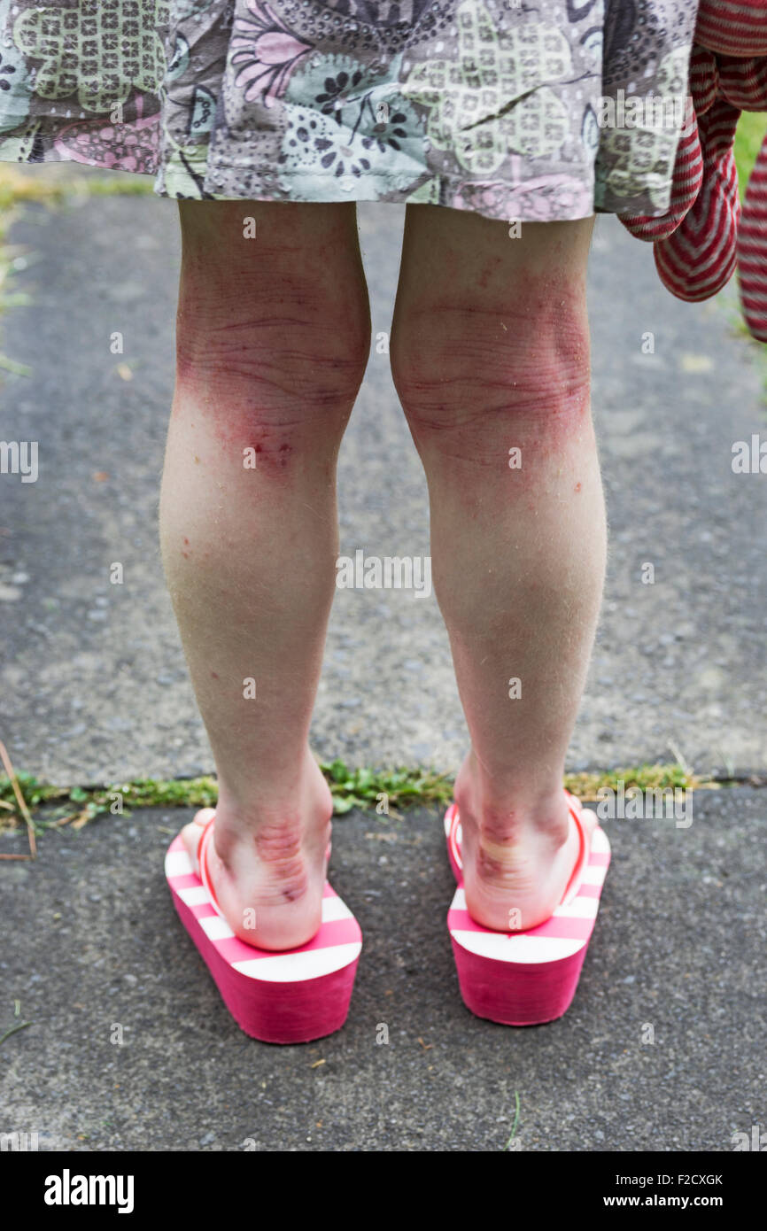 Eczema or dermatitis on the legs of a five year old girl. Stock Photo