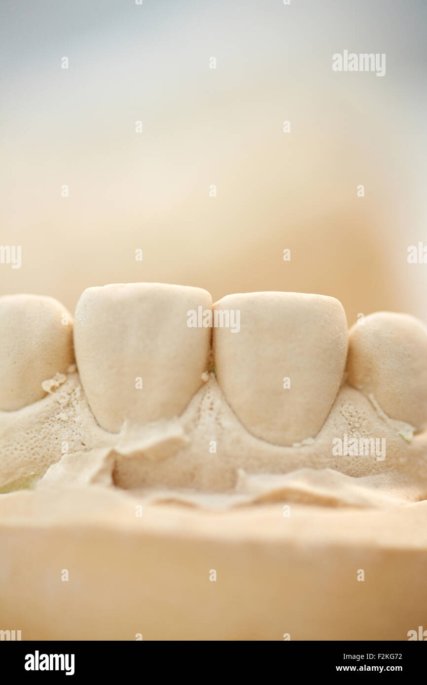 Plaster cast of upper front teeth in a dental lab Stock Photo