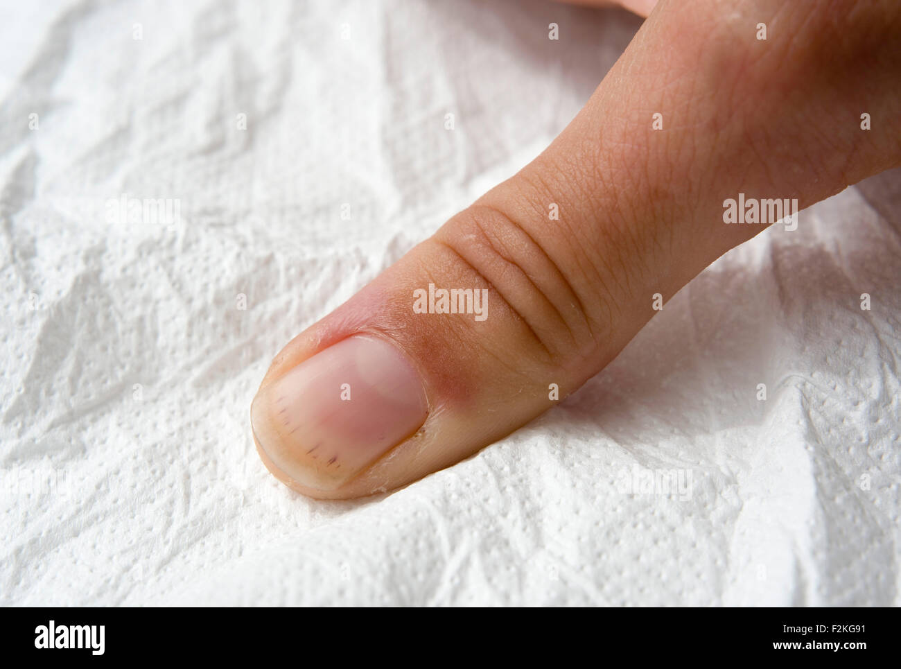 Nails, Splinter Hemorrhages In – Gluten Free Works: TREATMENT GUIDE
