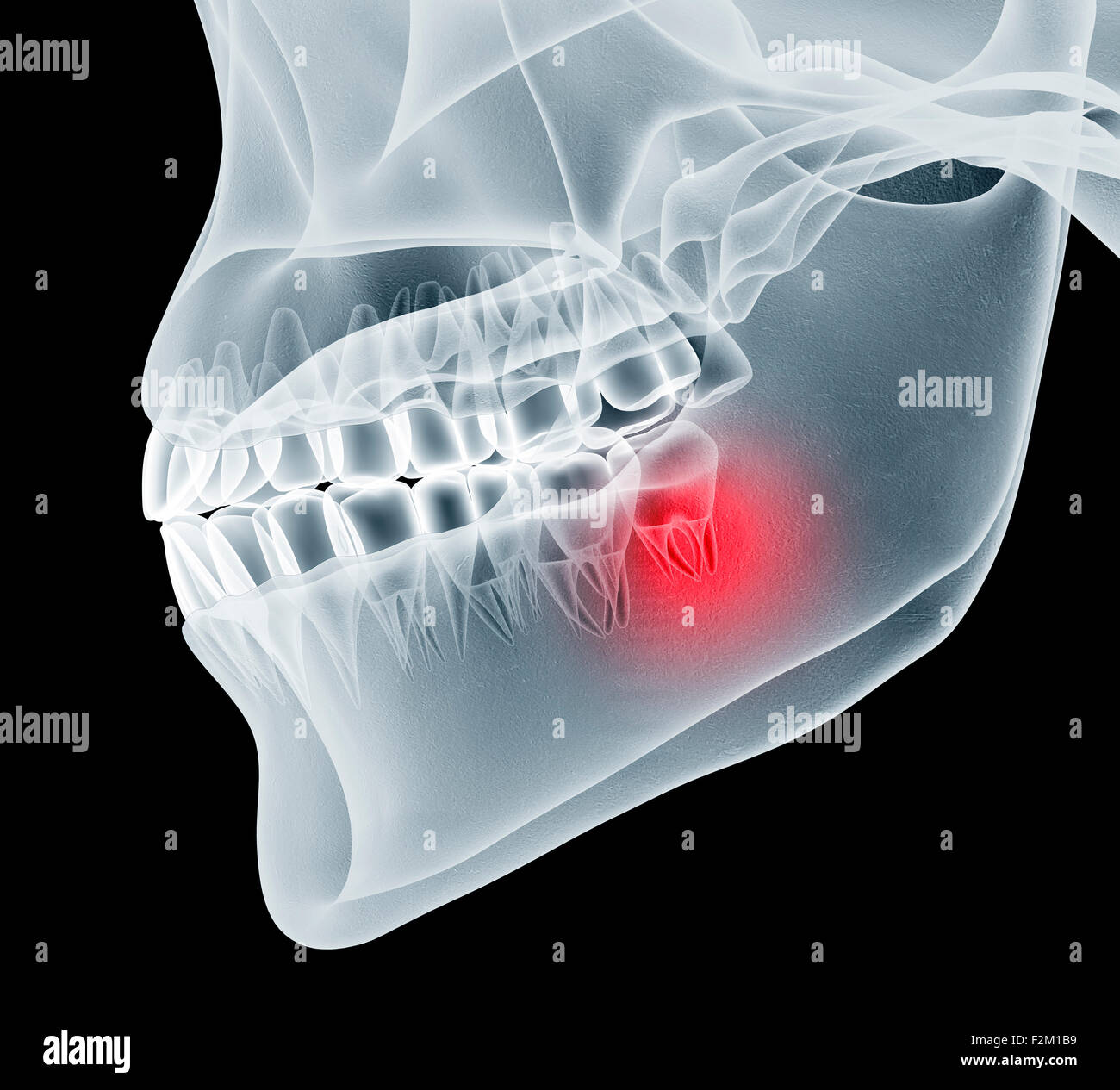 xray image of a jaw with teeth with one in pain Stock Photo Alamy