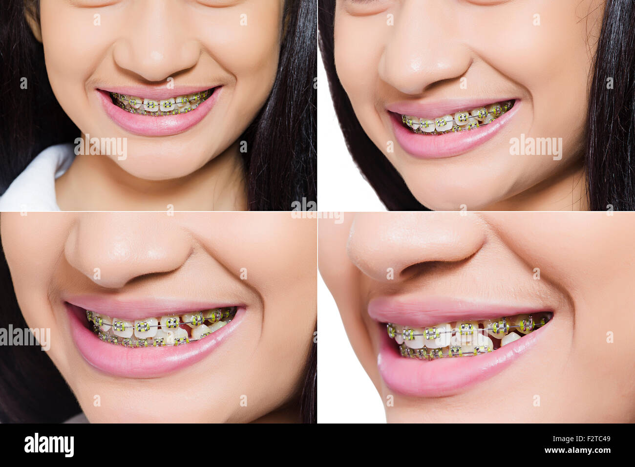1 indian Teenager Girl Comparison Teeth Stock Photo