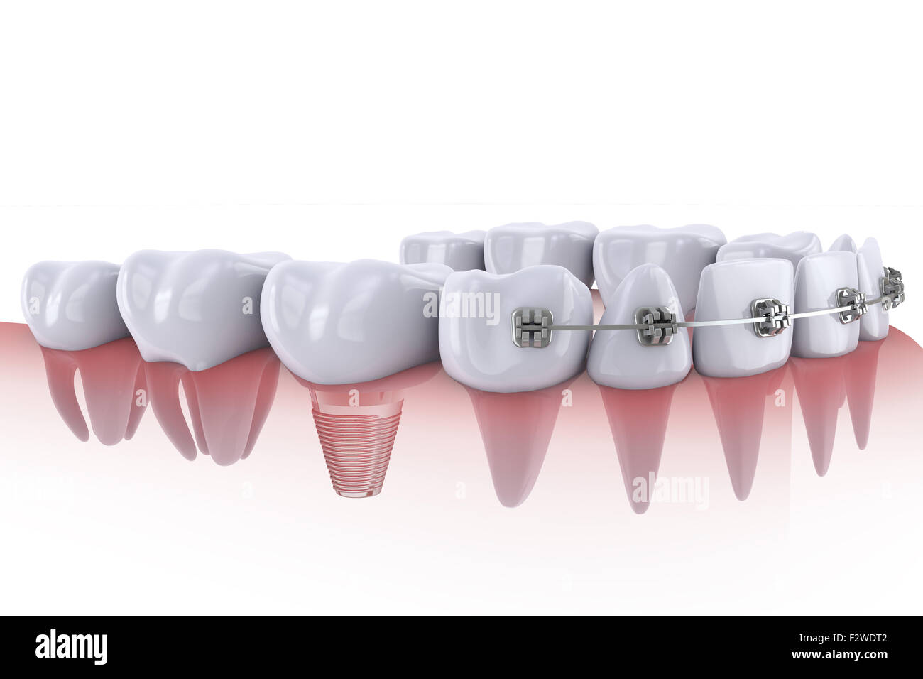 a teeth with braces and dental implants Stock Photo - Alamy